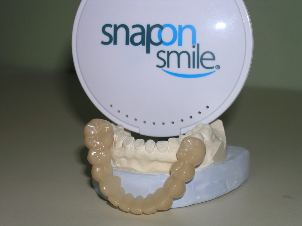 Snap-On Smile